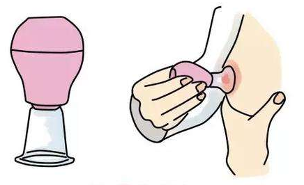 乳头内陷矫正需要多久恢复