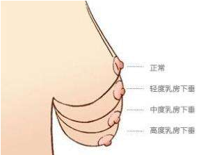 做乳房下垂提升手术哪家好