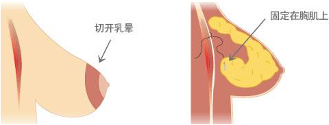 乳房下垂好不好