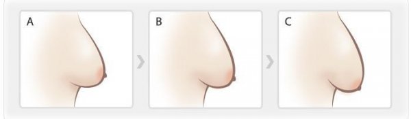 乳房提升术有哪些禁忌
