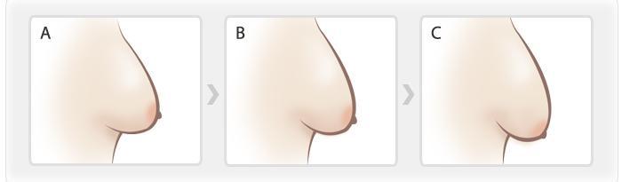 乳房提升术有哪些禁忌