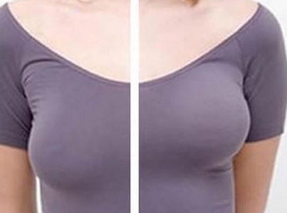 乳房悬吊术的特点