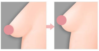 乳房下垂提升手术图片