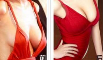 乳房下垂提升手术图片