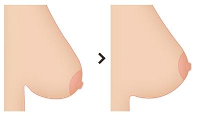 乳房下垂上提术