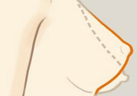 乳房下垂矫正术后不影响其他组织吗