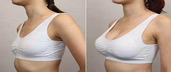 乳房下垂矫正在成年后任何年龄施行吗