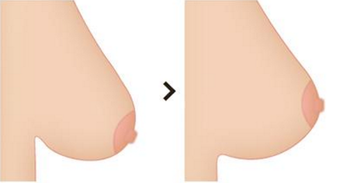 乳房下垂矫正是在乳晕作切口吗