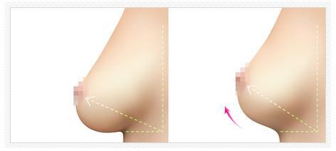 改善乳房下垂有什么好方法