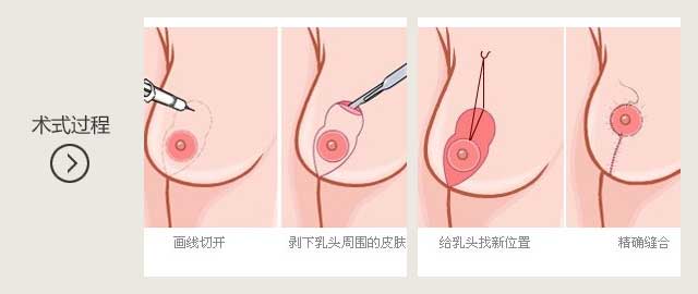 产后乳房下垂手术费用