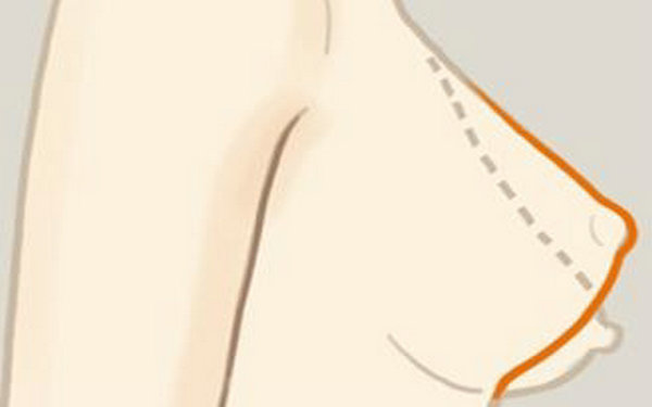 2种乳房下垂矫正术