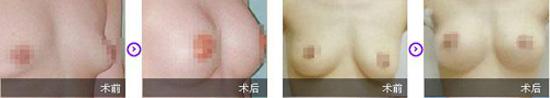 下垂能恢复吗