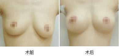 矫正乳房下垂手术前禁止吸烟