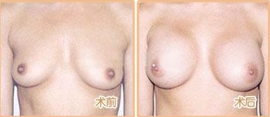 矫正乳房下垂手术全部过程