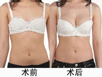 垂乳上提术的准备及并发症