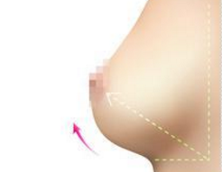 乳房下垂矫正后遗症