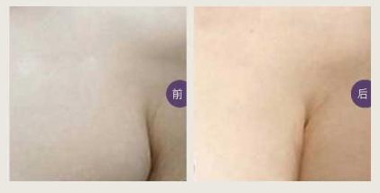 副乳整形后需要注意什么