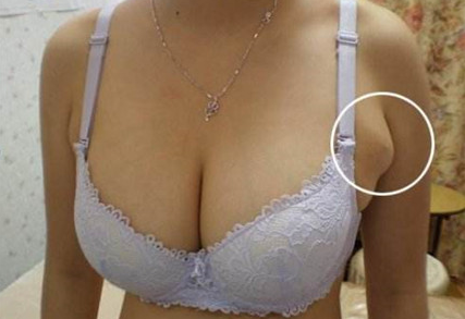 广州怎样消除副乳效果好