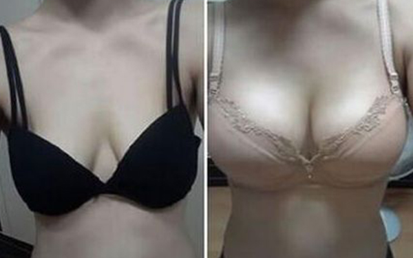 杭州副乳去除后要怎样护理