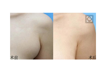 副乳切除术的宜忌人群