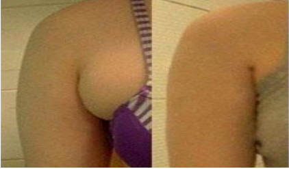 副乳切除手术不会留下任何疤痕