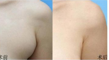 副乳切除术后需要注意哪些问题