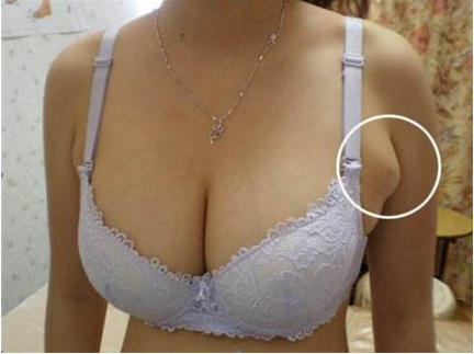 副乳切除术的并发症