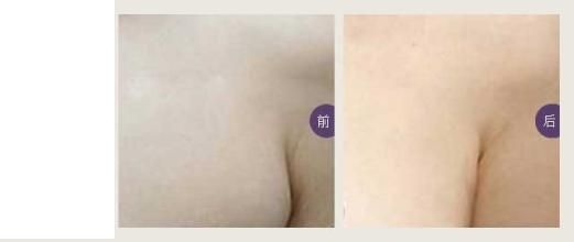 副乳切除及价格介绍