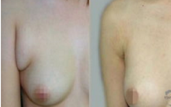 副乳切除后伤口会裂开吗