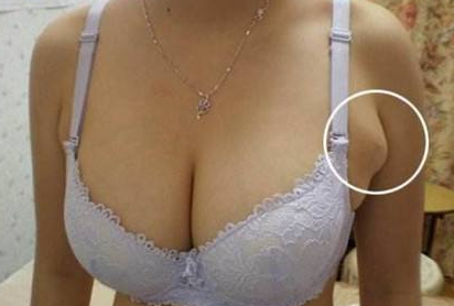 副乳有哪些症状