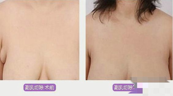 吸脂去除副乳会影响胸型吗