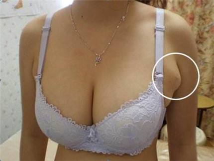 副乳消除手术要多少钱