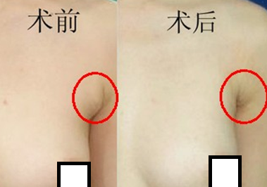 上海副乳切除需要多少钱