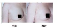 副乳切除术过程