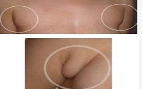 副乳的形成和切除手术介绍