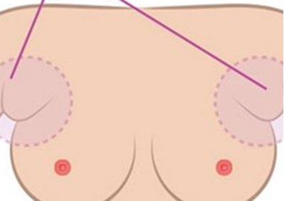 怀孕期间可以切除副乳吗