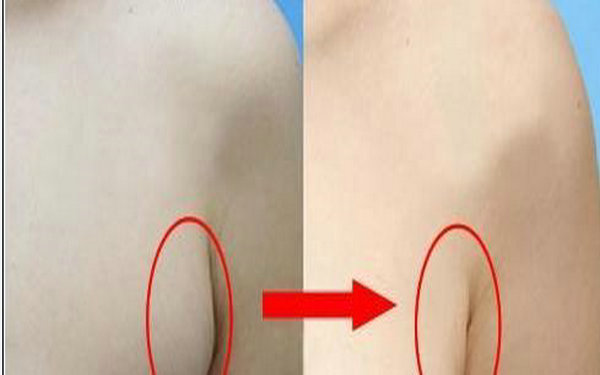 解析哪些人不适合做副乳切除术