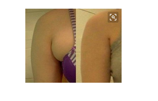 副乳的治疗方法有哪些