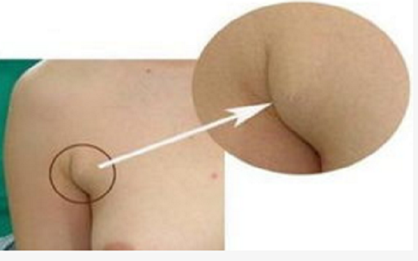 副乳一定要切除吗