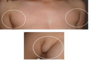 副乳切除方式是抽脂好还是切除好