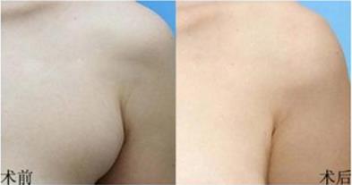 手术去除和吸脂去除副乳的特征