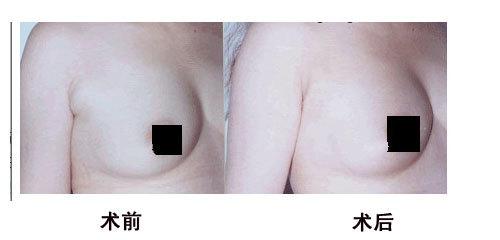 副乳切除的价格因素