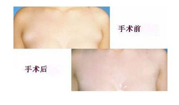 副乳形成的原因及手术护理