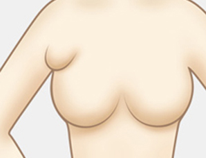 副乳有害吗？有没有必要切除