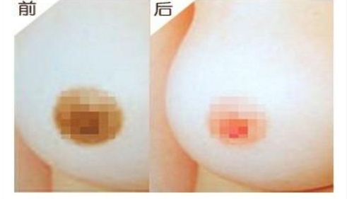 广州乳晕整形怎么样效果好不好 