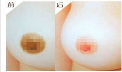 乳晕缩小术非常安全吗