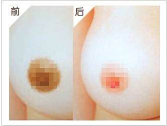 北京乳晕切割手术多少钱