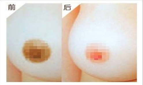上海乳晕整形手术真的很快捷吗
