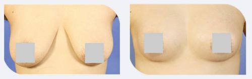 乳晕缩小整形手术有哪些禁忌症