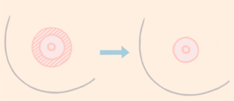 乳晕缩小手术的注意事项